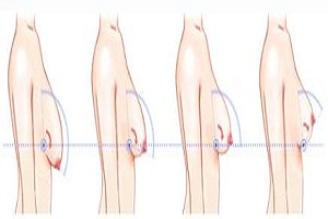 乳房下垂矫正术有哪些需要注意的