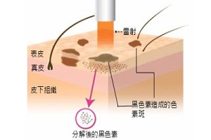 激光去雀斑 快速去除面部“黑子”