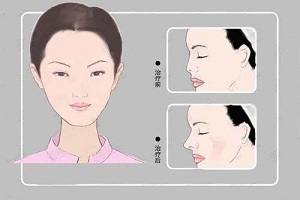 上海玻尿酸隆鼻效果如何