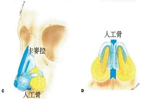 韩式隆鼻术属于假体隆鼻吗