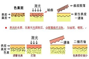 什么是老年斑呢