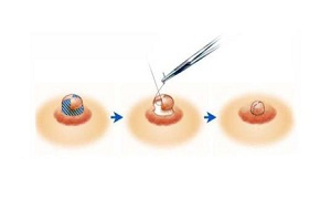 乳晕缩小术的特点及注意事项