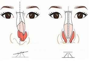 弯鼻梁该如何改弯取直呢