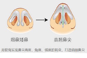 鼻型矫正之短鼻延长