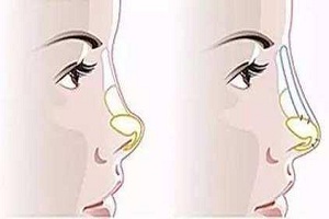 鼻型矫正之短鼻延长