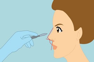 简述假体隆鼻的方法