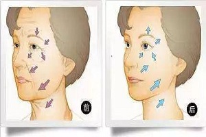 电波拉皮，有“冰”更好
