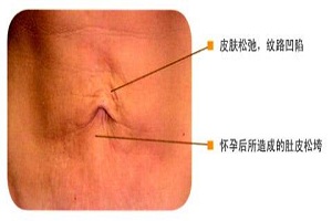 电波拉皮，有“冰”更好