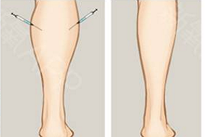 吸脂瘦腿术后注意事项