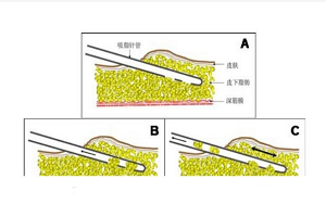 吸脂瘦腿要注意哪些问题