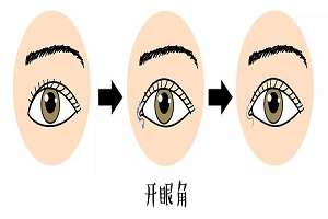 影响开眼角手术价格的因素是什么