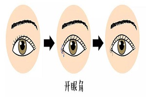 开内眼角手术要多少钱