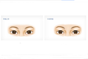 双眼皮手术后如何避免留疤