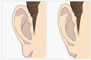 耳垂畸形的几种表现特点