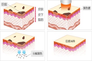 激光去痣的价格一般是多少