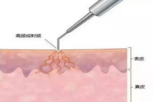 激光祛痣要注意些什么