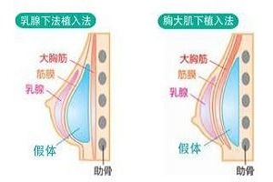 假体隆胸手术后护理有哪些