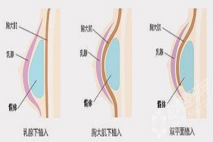 假体隆胸术后护理应当注意什么