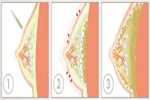 自体脂肪丰胸有哪些优点