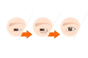 去眼袋手术要规避三个误区