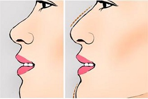 隆鼻手术的常见问题有哪些
