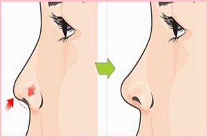 常见的隆鼻方法有哪些