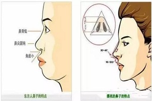 三大常见的隆鼻手术方法