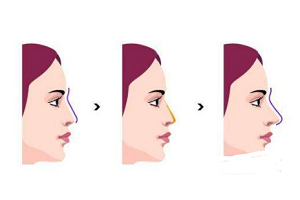 隆鼻手术的注意事项有哪些呢