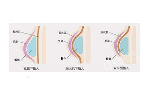 隆胸的方法有哪些