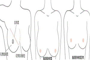 胸部整形失败后如何修复最理想