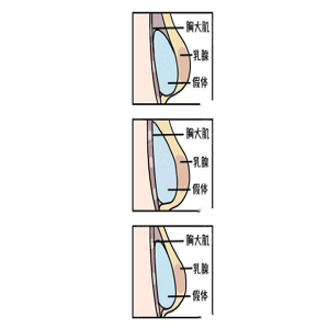假体隆胸后是否有这些问题呢