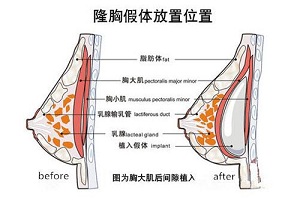 假体隆胸上移怎么修复