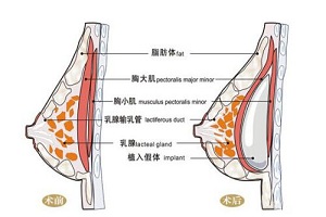 假体隆胸后出现手感僵硬不柔软怎么办