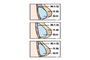 假体丰胸的适用人群