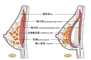 假体隆胸会有哪些副作用