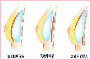 假体隆胸术后胸部的手感怎样