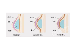 假体隆胸以后还需要更换假体吗