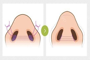 鼻头缩小术的价格