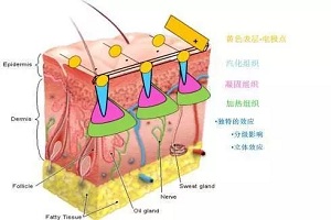 激光怎么祛鱼尾纹呢