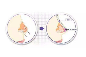 硅胶隆鼻假体是不是永久的呢