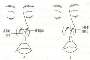 韩式隆鼻手术的优点