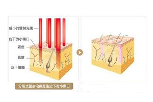 激光除皱 还你如花笑颜