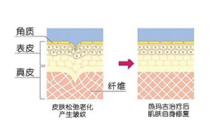 激光除皱的几个优点