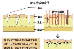 激光除皱的价格是多少