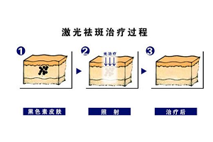 激光祛斑的优势有哪些