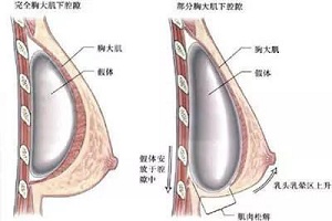 硅胶隆胸的材料是怎么样的