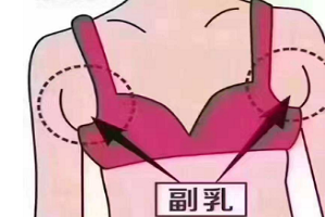 副乳切除术后要注意什么