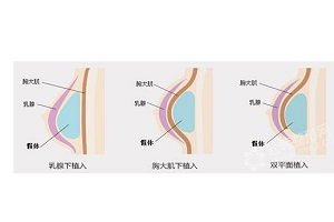 进行假体隆胸术该注意些什么呢