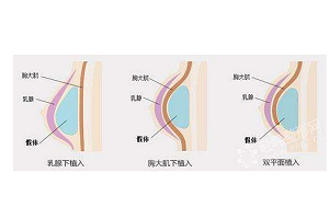 隆胸手术的假体是越软越好吗