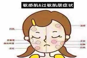 红血丝形成的原因是什么呢